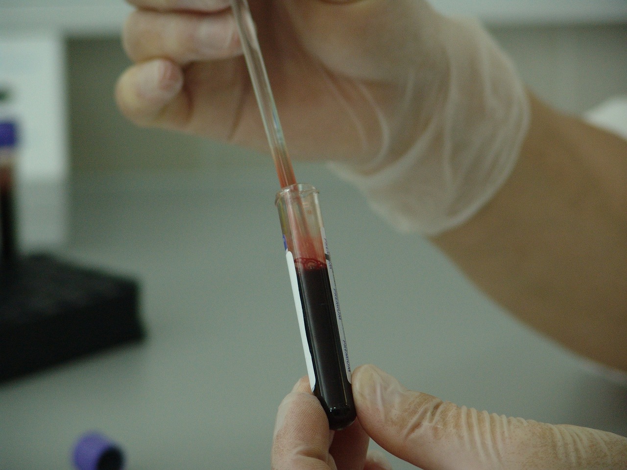 Prix prise de sang sans ordonnance : Découvrez les tarifs pour des analyses sanguines sans prescription médicale